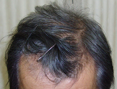 男性用発毛剤「Dott Hair for Men」(ドットヘアー) | 大阪市 北区 南