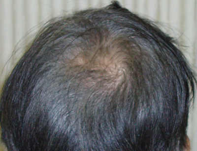 男性用発毛剤 Dott Hair For Men ドットヘアー 大阪市 北区 南森町 ゆかり皮膚科 ケミカルピーリング 育毛治療 男性用発毛剤 Dott Hair For Men ドットヘアー 大阪市 北区 南森町 ゆかり皮膚科 ケミカルピーリング 育毛治療